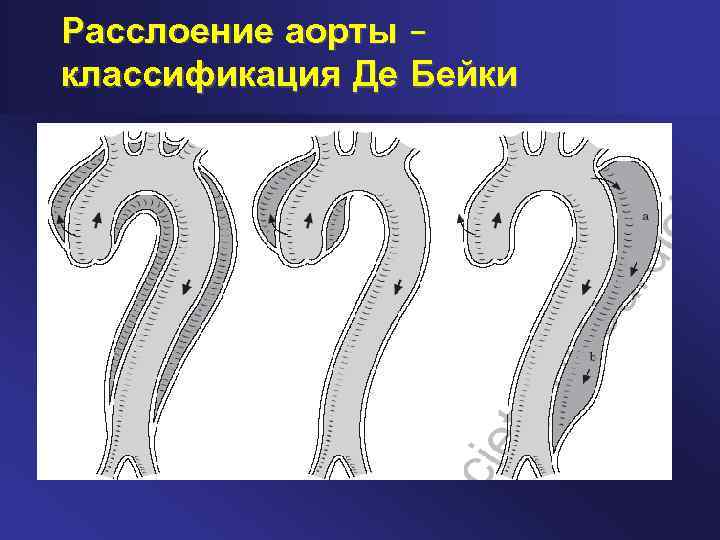 Расслоение аорты – классификация Де Бейки 
