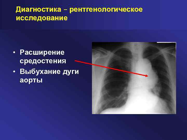 Диагностика – рентгенологическое исследование • Расширение средостения • Выбухание дуги аорты 