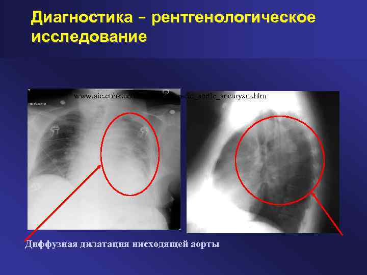 Диагностика – рентгенологическое исследование www. aic. cuhk. edu. hk/web 8/thoracic_aortic_aneurysm. htm Диффузная дилатация нисходящей