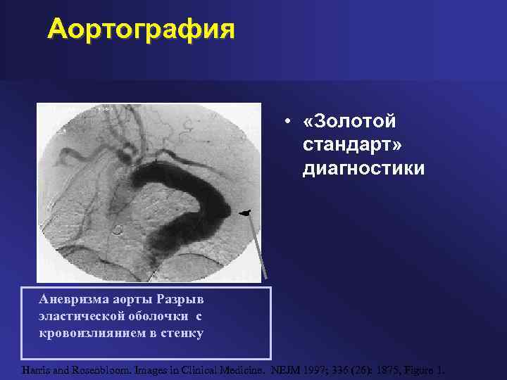 Аортография • «Золотой стандарт» диагностики Аневризма аорты Разрыв эластической оболочки с кровоизлиянием в стенку