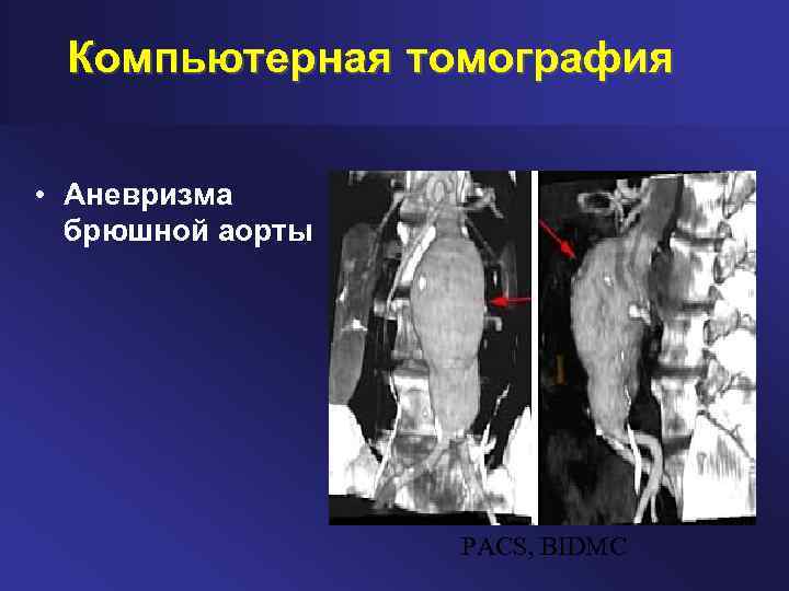 Компьютерная томография • Аневризма брюшной аорты PACS, BIDMC 