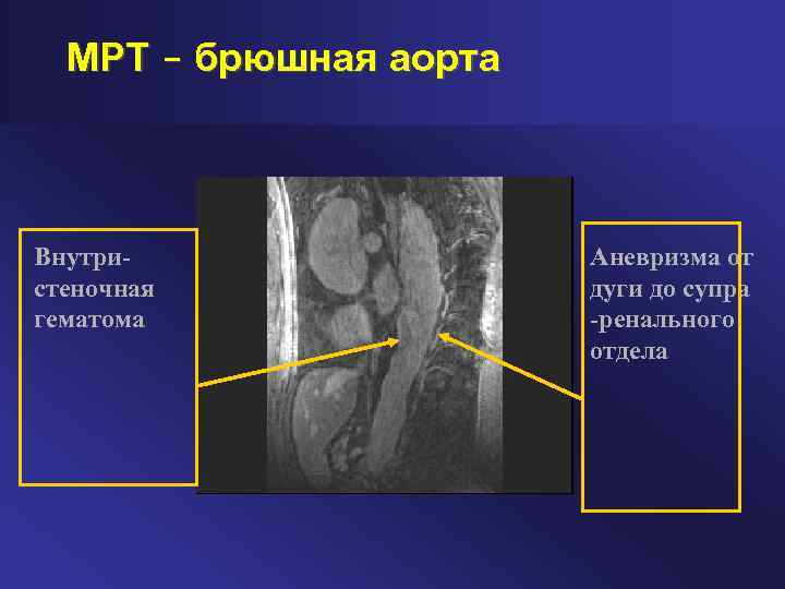 МРТ – брюшная аорта Внутристеночная гематома Аневризма от дуги до супра -ренального отдела 