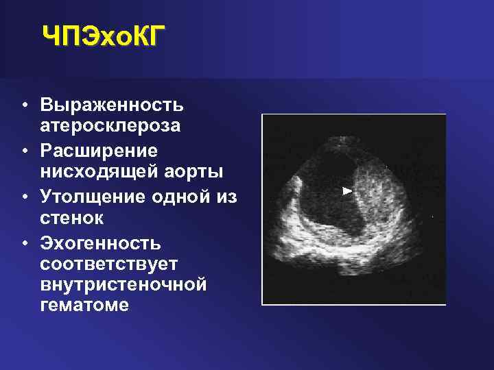 ЧПЭхо. КГ • Выраженность атеросклероза • Расширение нисходящей аорты • Утолщение одной из стенок