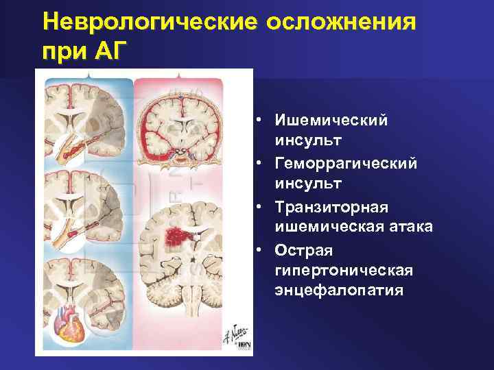 Неврологические осложнения при АГ • Ишемический инсульт • Геморрагический инсульт • Транзиторная ишемическая атака