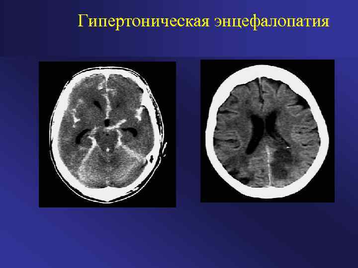 Гипертоническая энцефалопатия 