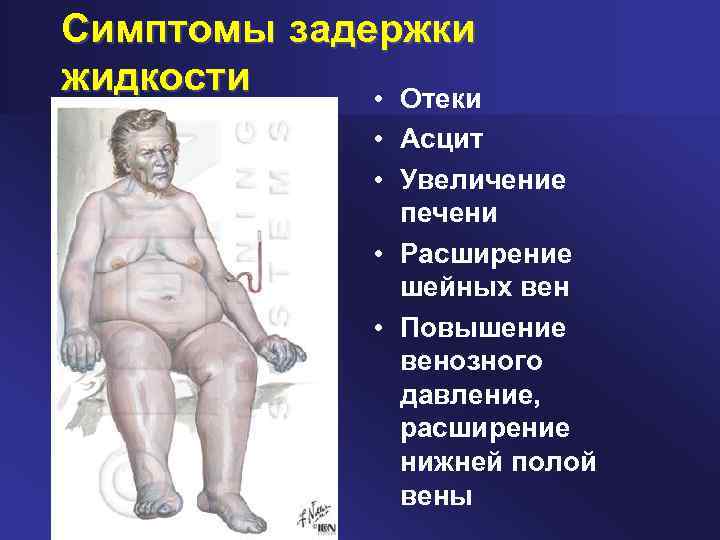 Симптомы задержки жидкости • Отеки • Асцит • Увеличение печени • Расширение шейных вен