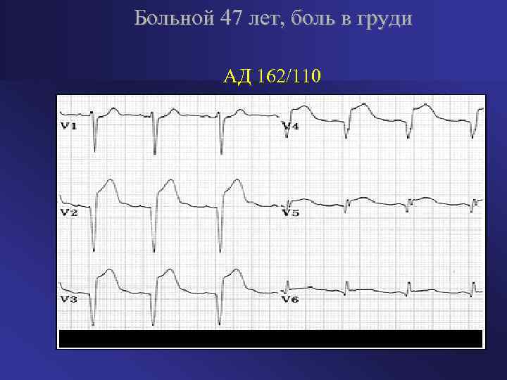 Больной 47 лет, боль в груди АД 162/110 