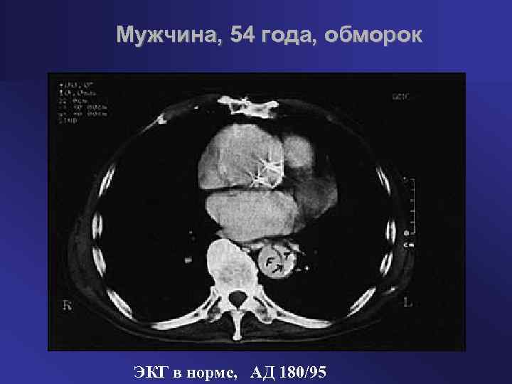 Мужчина, 54 года, обморок ЭКГ в норме, АД 180/95 