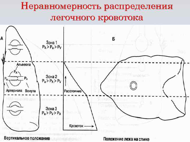 Неравномерность распределения легочного кровотока 