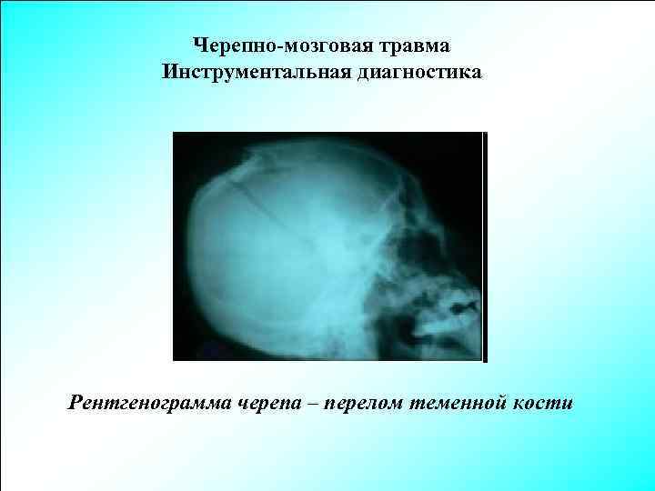 Черепно-мозговая травма Инструментальная диагностика Рентгенограмма черепа – перелом теменной кости 