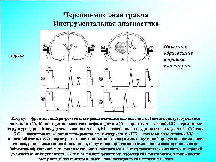 Черепно-мозговая травма Инструментальная диагностика норма Объемное образование в правом полушарии Вверху — фронтальный разрез