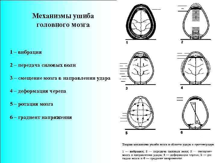 Механизмы ушиба головного мозга 1 – вибрация 2 – передача силовых волн 3 –