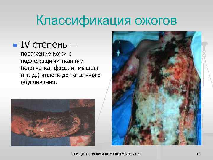 Классификация ожогов n IV степень — поражение кожи с подлежащими тканями (клетчатка, фасции, мышцы