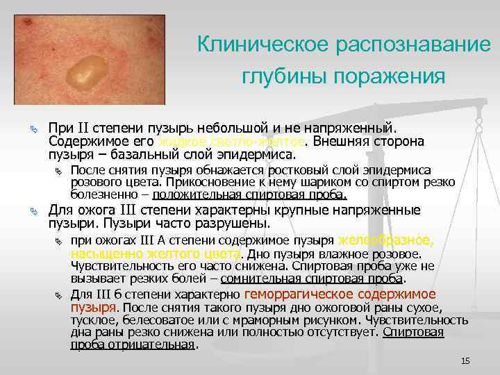 Клиническое распознавание глубины поражения Ä При II степени пузырь небольшой и не напряженный. Содержимое