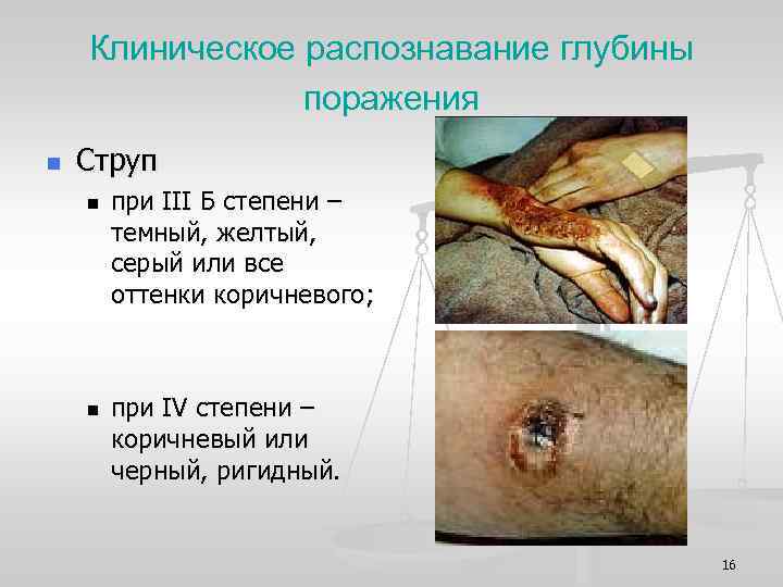 Клиническое распознавание глубины поражения n Струп n n при III Б степени – темный,