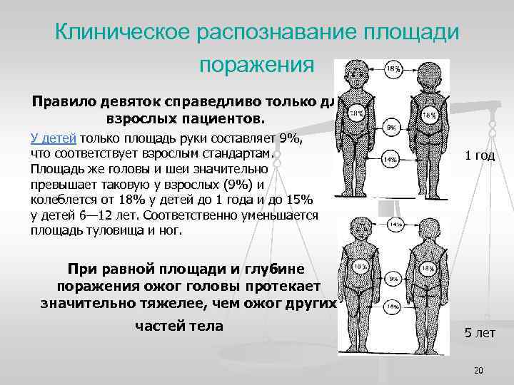 Клиническое распознавание площади поражения Правило девяток справедливо только для взрослых пациентов. У детей только