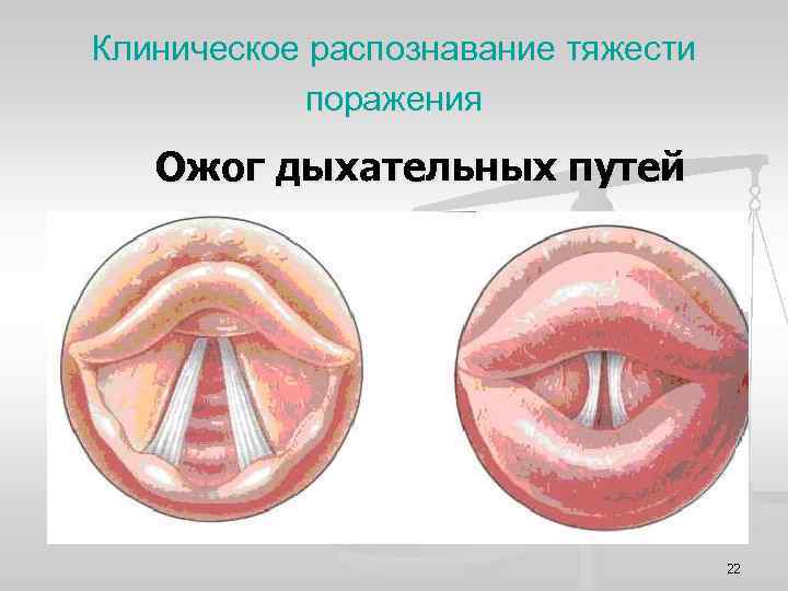 Клиническое распознавание тяжести поражения Ожог дыхательных путей 22 