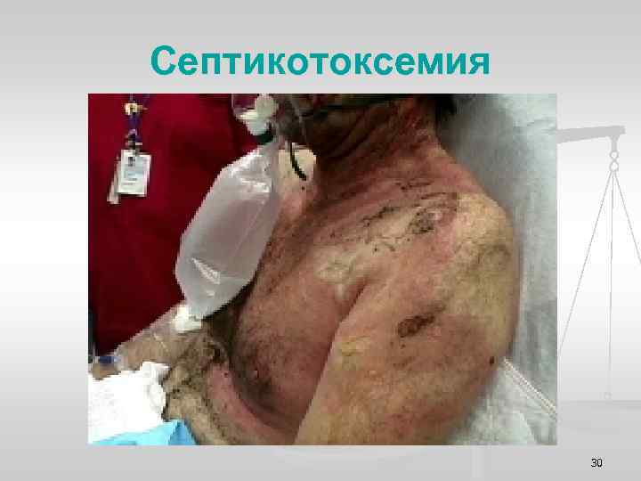 Септикотоксемия 30 