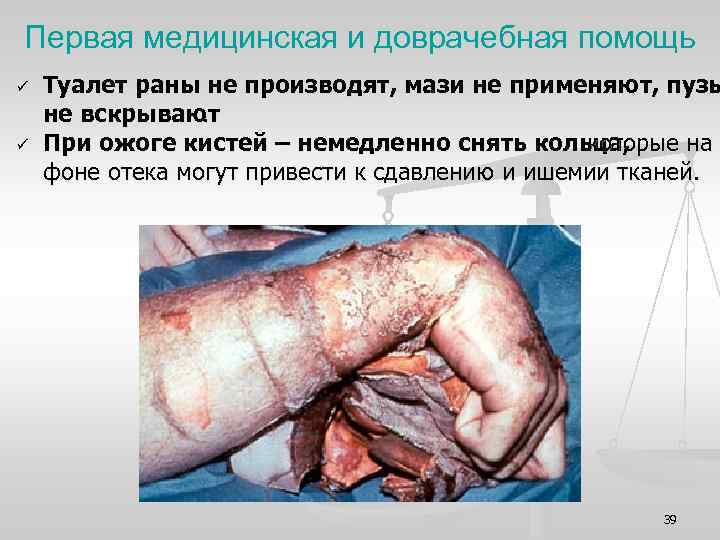 Первая медицинская и доврачебная помощь ü ü Туалет раны не производят, мази не применяют,