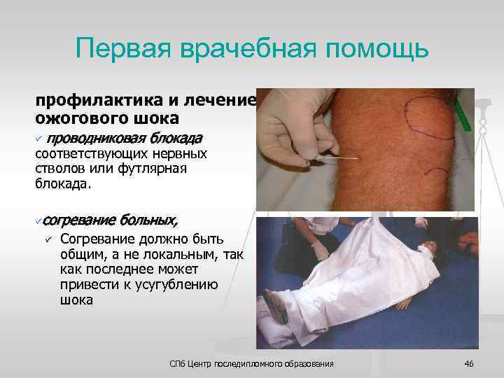 Первая врачебная помощь профилактика и лечение ожогового шока ü проводниковая блокада соответствующих нервных стволов