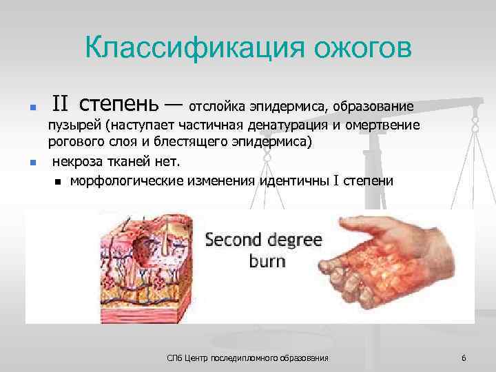 Классификация ожогов n n II степень — отслойка эпидермиса, образование пузырей (наступает частичная денатурация