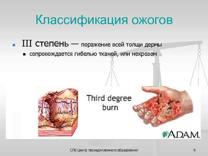 Классификация ожогов n III степень — поражение всей толщи дермы n сопровождается гибелью тканей,