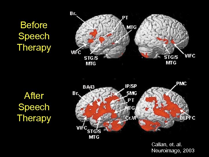 Before Speech Therapy After Speech Therapy Callan, et. al. Neuroimage, 2003 