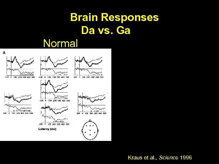 Brain Responses Da vs. Ga Normal Learning Impaired Kraus et al. , Science 1996