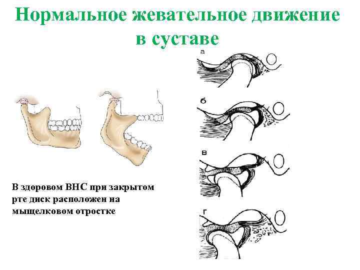 Нормальное жевательное движение в суставе В здоровом ВНС при закрытом рте диск расположен на