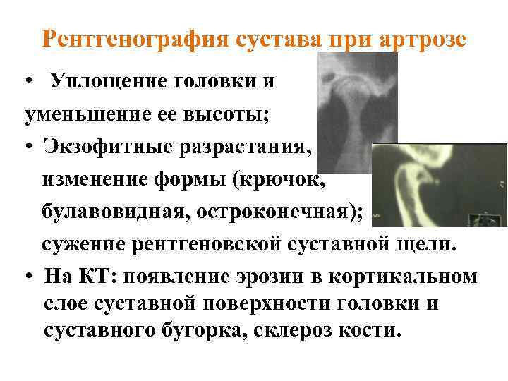 Рентгенография сустава при артрозе • Уплощение головки и уменьшение ее высоты; • Экзофитные разрастания,