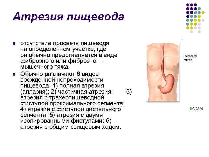 Атрезия пищевода l l отсутствие просвета пищевода на определенном участке, где он обычно представляется