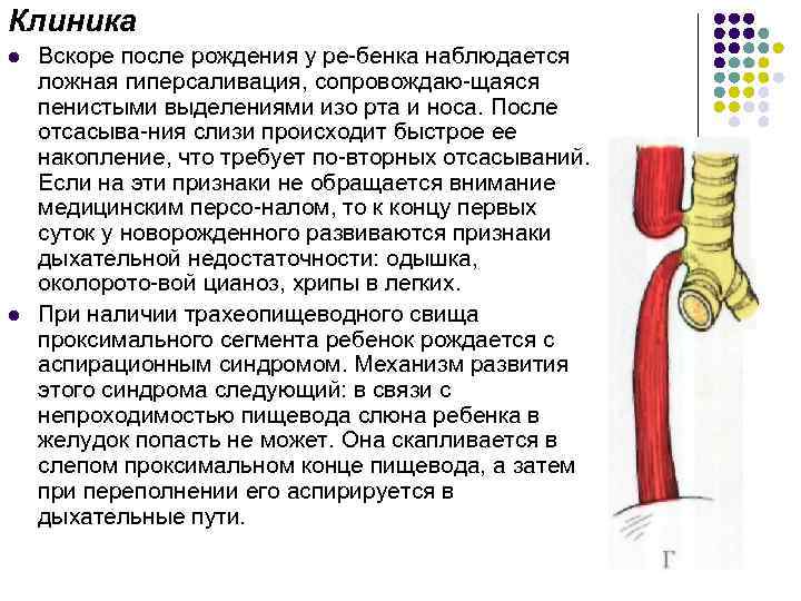 Клиника l l Вскоре после рождения у ре бенка наблюдается ложная гиперсаливация, сопровождаю щаяся