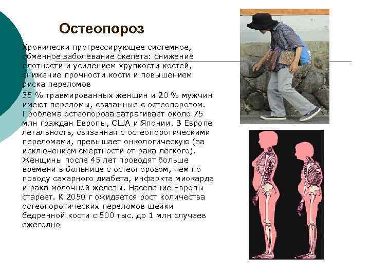 Остеопороз Хронически прогрессирующее системное, обменное заболевание скелета: снижение плотности и усилением хрупкости костей, снижение