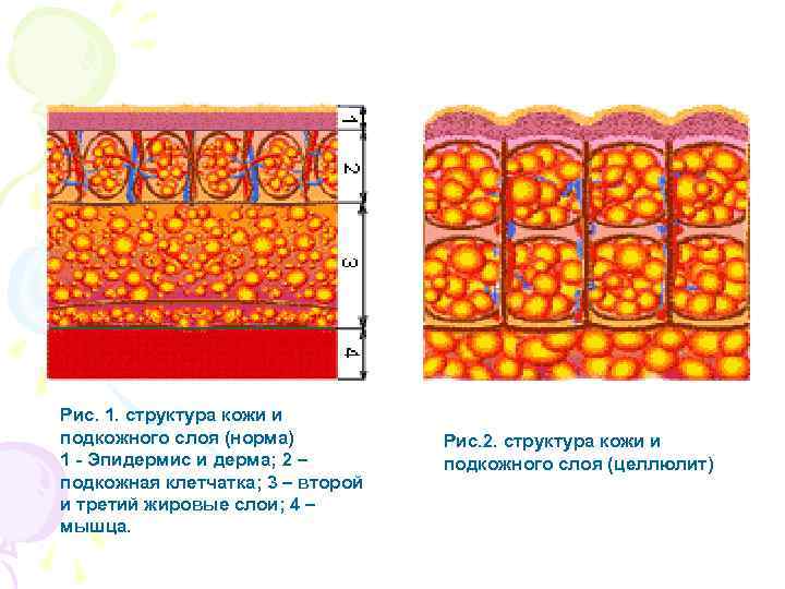 Рис. 1. структура кожи и подкожного слоя (норма) 1 - Эпидермис и дерма; 2