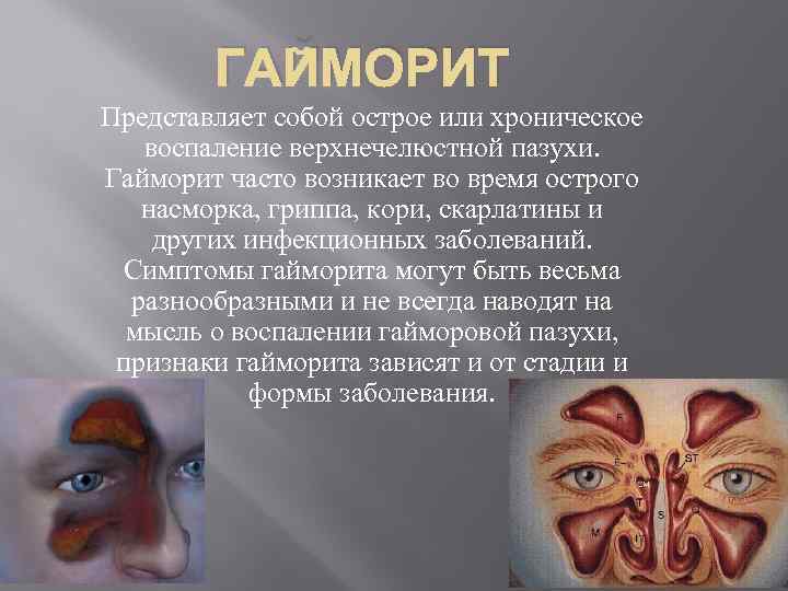 ГАЙМОРИТ Представляет собой острое или хроническое воспаление верхнечелюстной пазухи. Гайморит часто возникает во время