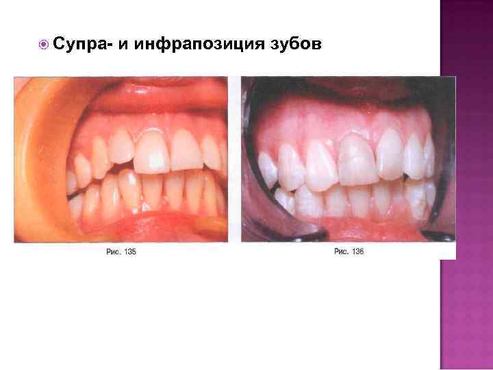  Супра- и инфрапозиция зубов 