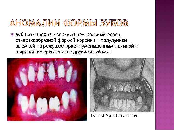  зуб Гетчинсона - верхний центральный резец отверткообразной формой коронки и полулунной выемкой на