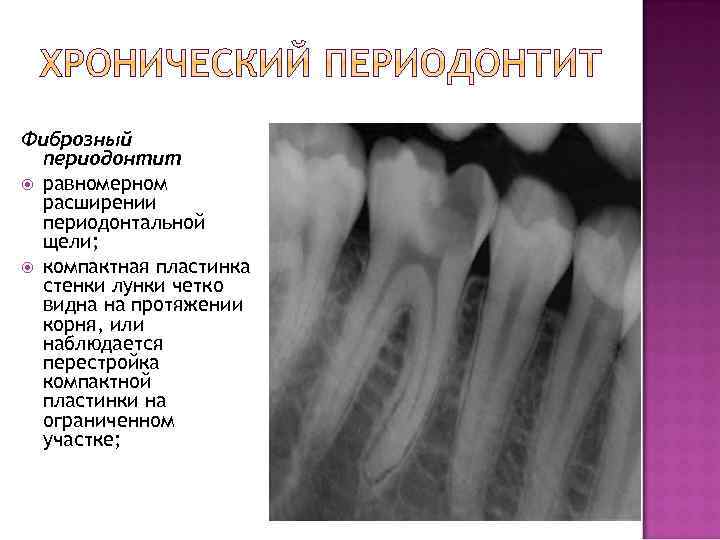 Фиброзный периодонтит равномерном расширении периодонтальной щели; компактная пластинка стенки лунки четко видна на протяжении