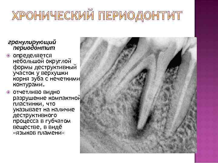 гранулирующий периодонтит определяется небольшой округлой формы деструктивный участок у верхушки корня зуба с нечеткими