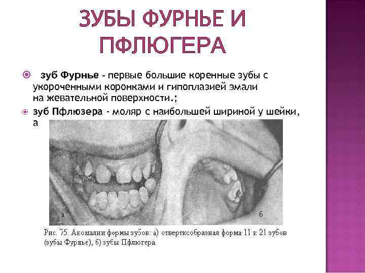 ЗУБЫ ФУРНЬЕ И ПФЛЮГЕРА зуб Фурнье - первые большие коренные зубы с укороченными коронками