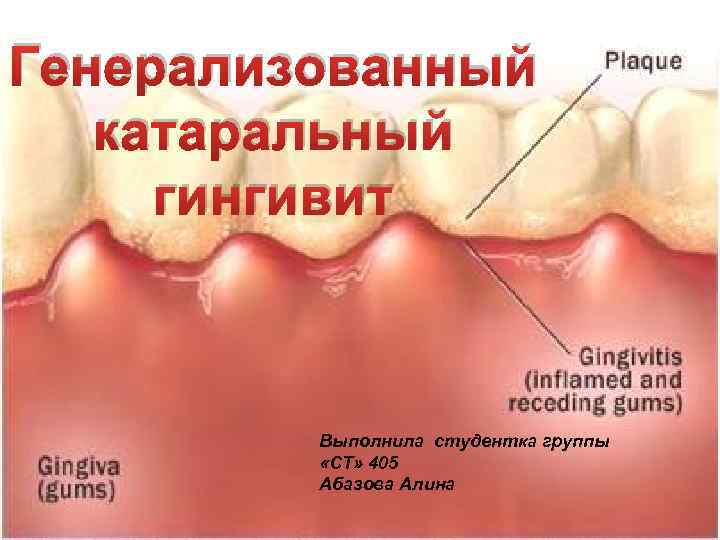 Генерализованный катаральный гингивит Выполнила студентка группы «СТ» 405 Абазова Алина 