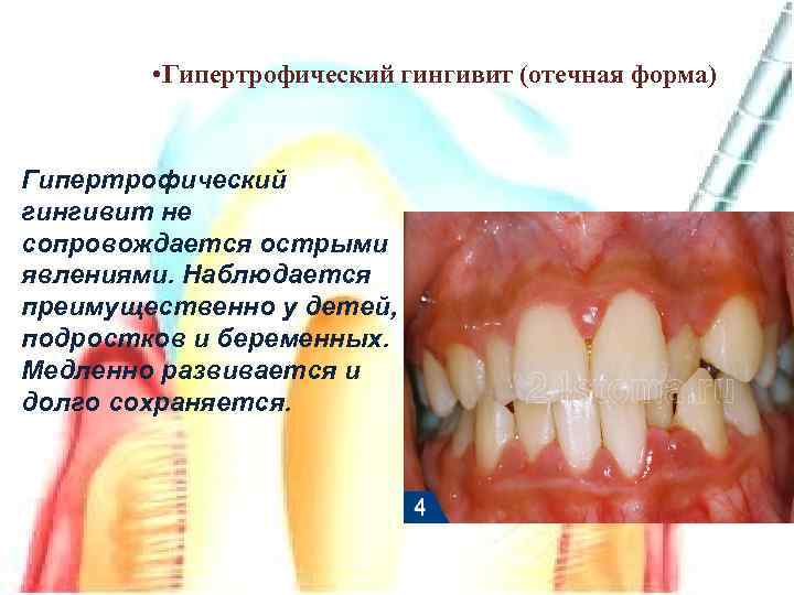  • Гипертрофический гингивит (отечная форма) Гипертрофический гингивит не сопровождается острыми явлениями. Наблюдается преимущественно