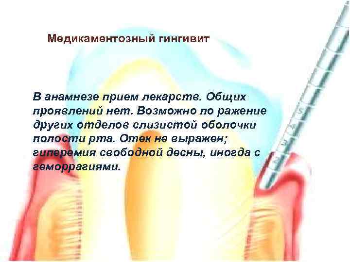 Медикаментозный гингивит В анамнезе прием лекарств. Общих проявлений нет. Возможно по ражение других отделов