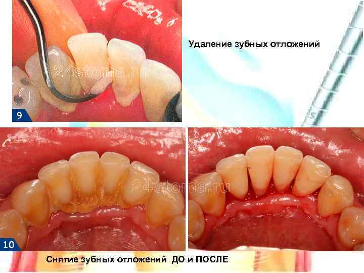 Удаление зубных отложений Снятие зубных отложений ДО и ПОСЛЕ 