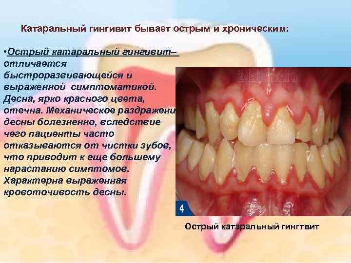 Катаральный гингивит бывает острым и хроническим: • Острый катаральный гингивит– отличается быстроразвивающейся и выраженной