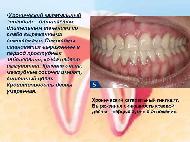  • Хронический катаральный гингивит – отличается длительным течением со слабо выраженными симптомами. Симптомы