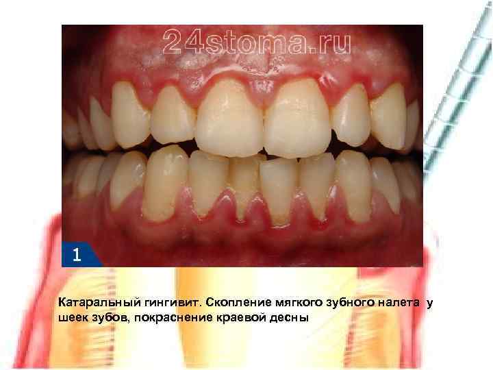 Катаральный гингивит. Скопление мягкого зубного налета у шеек зубов, покраснение краевой десны 