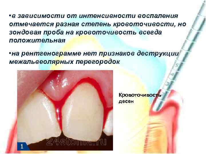  • в зависимости от интенсивности воспаления отмечается разная степень кровоточивости, но зондовая проба