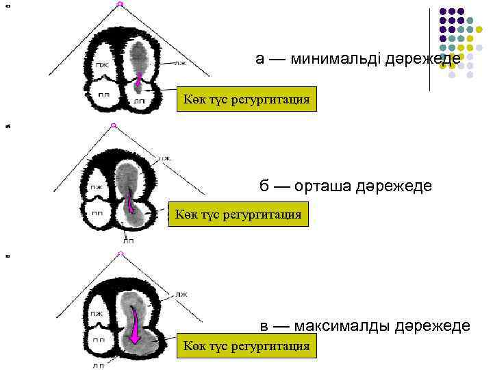 а — минимальді дәрежеде Көк түс регургитация б — орташа дәрежеде Көк түс регургитация