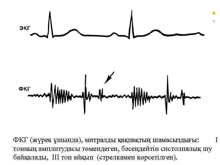 ФКГ (жүрек ұшында), митралды қақпақтың шамасыздығы: І итралды қақпақтың шамасыздығы тонның амплитудасы төмендеген, бәсеңдейтін